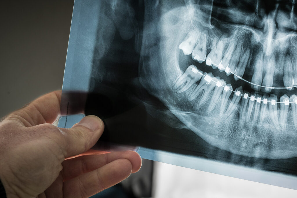 Bone Loss in Teeth